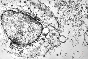F, 62y. | myxoma atrii F, 62y. | myxoma atrii